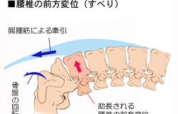 腰椎のすべりによる腰痛について（予防法）